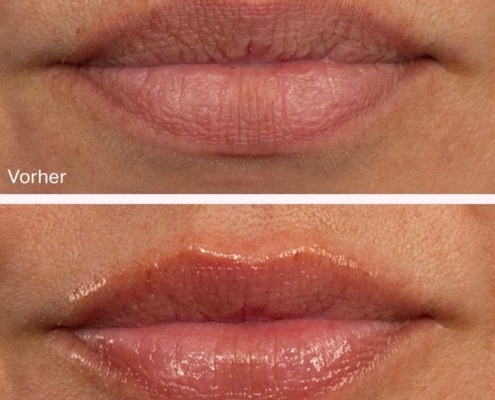 Hydrafacial